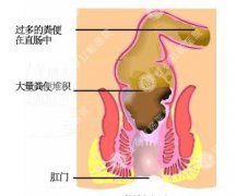 便秘了用大肠水疗真的有